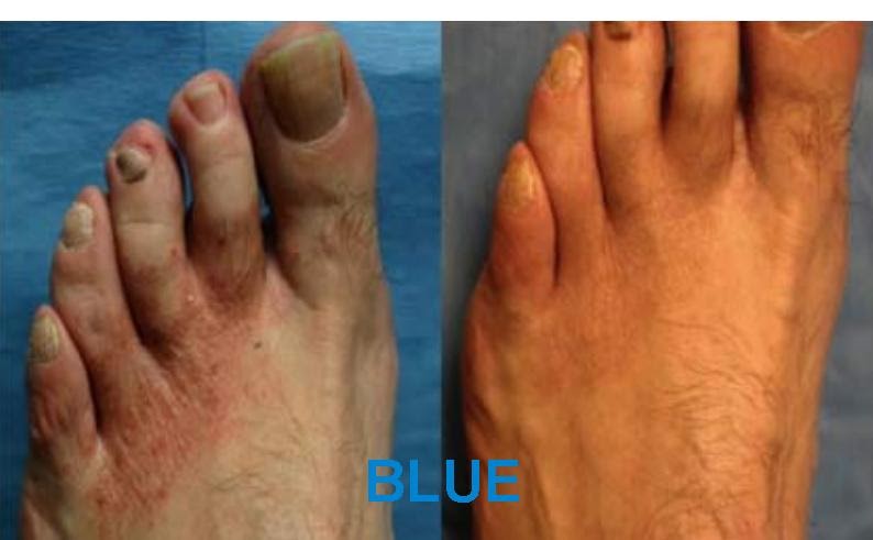 Los indicios del hongo sobre los dedos de los pies que curar